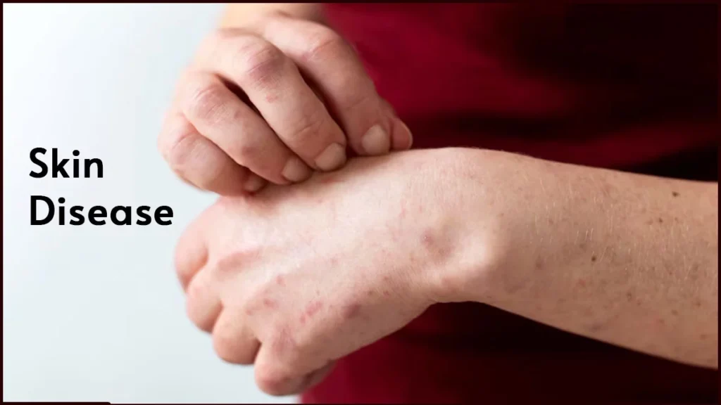 Common Skin Diseases : Types, Symptoms And Prevention