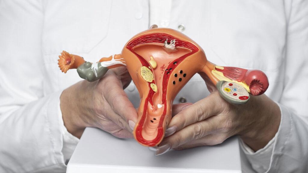 Everything You Need to Know About Intrauterine Contraceptive Devices